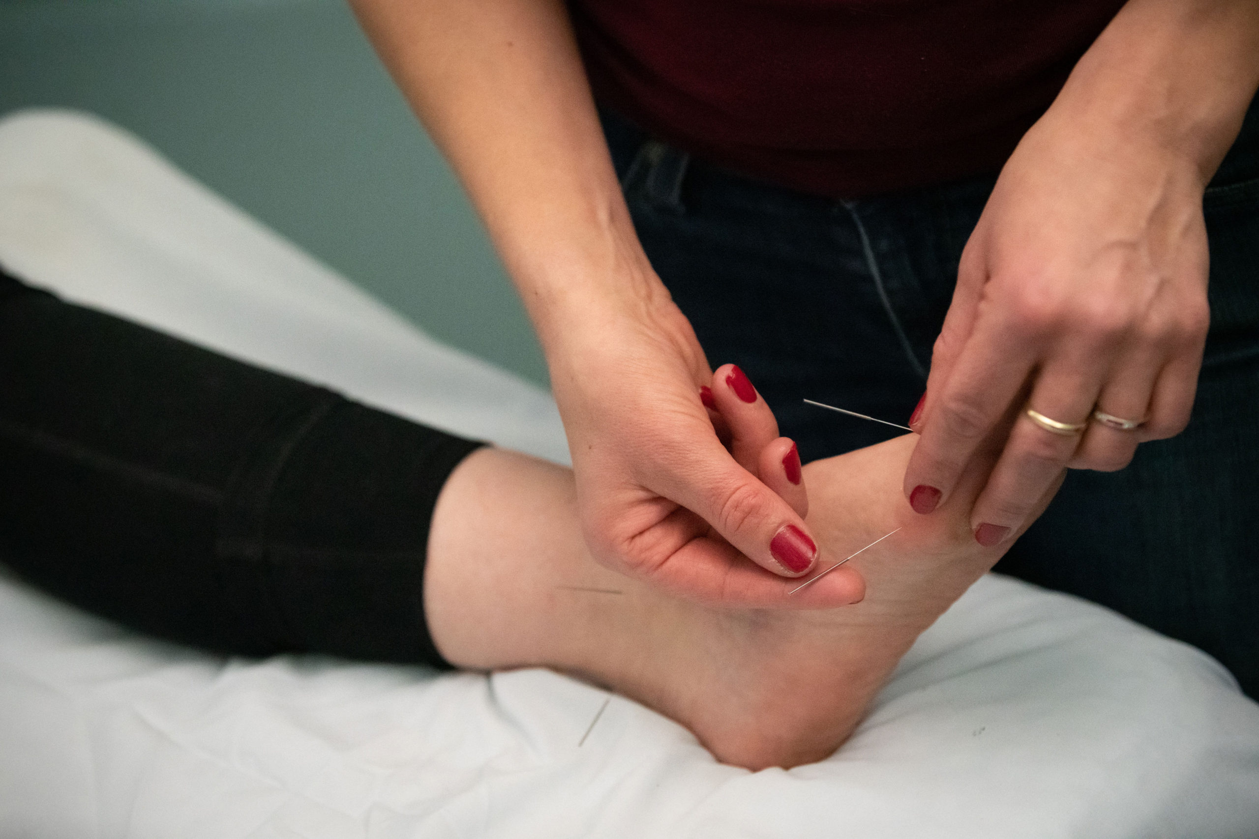 acupuncture being done on a foot